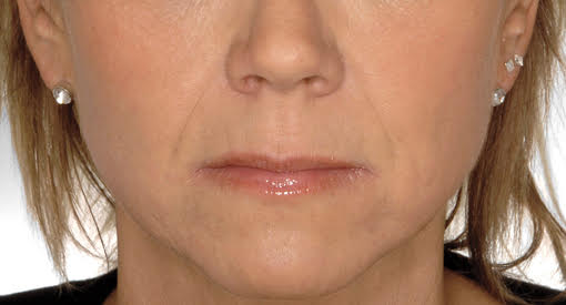 לפני ואחרי טיפול בחומצה היאלורונית​