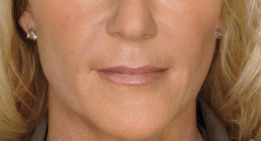 לפני ואחרי טיפול בחומצה היאלורונית​