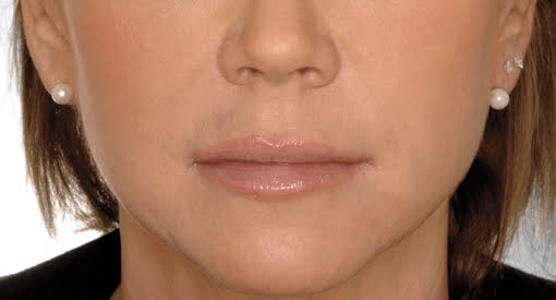 לפני ואחרי טיפול בחומצה היאלורונית​