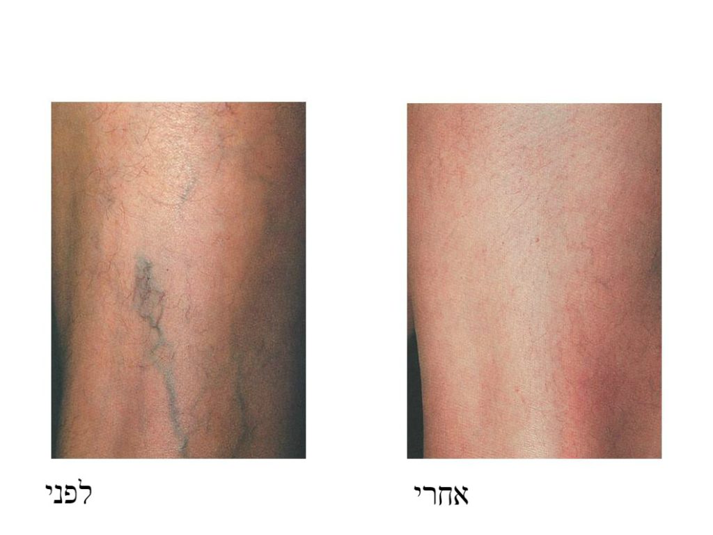 לפני ואחרי טיפול בוורידי ונימי רגליים