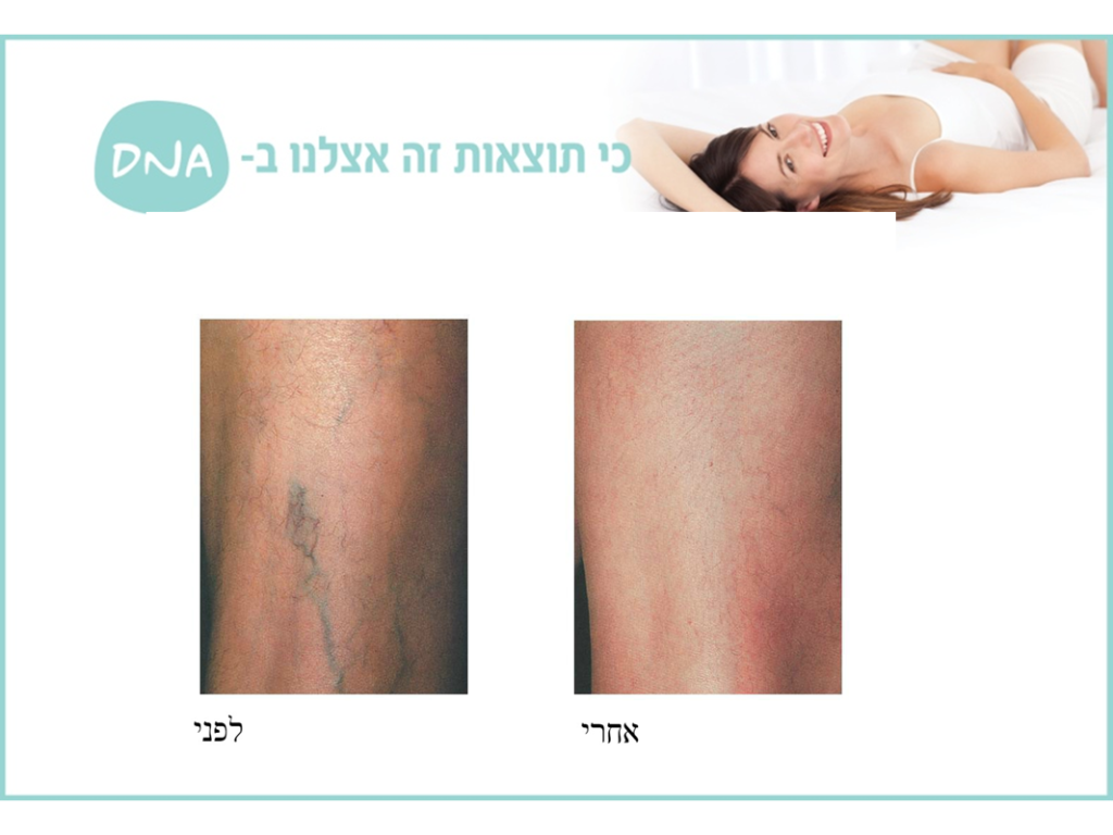 לפני ואחרי טיפול בוורידי ונימי רגליים