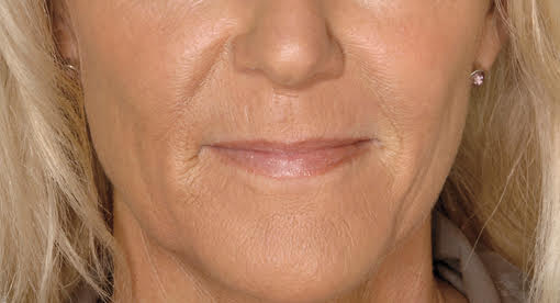 לפני ואחרי טיפול בחומצה היאלורונית​